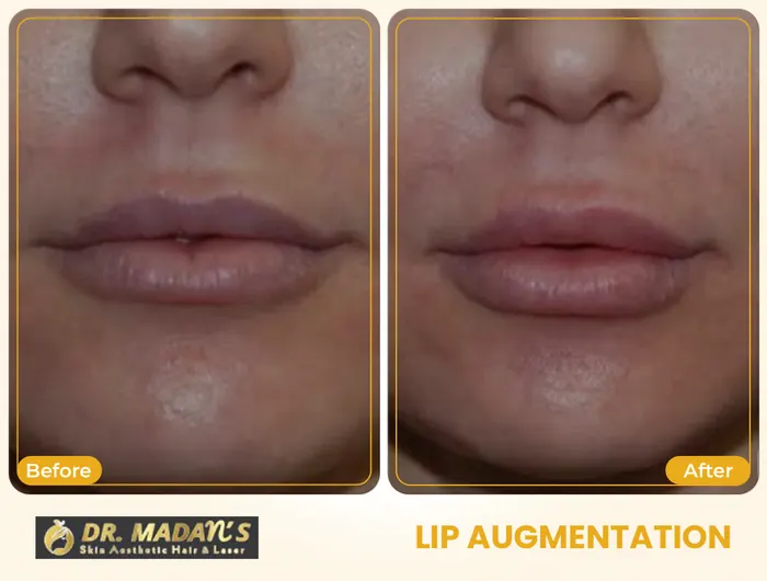 Lip augmentation before and after result 1 at Dr Madan Aesthetics